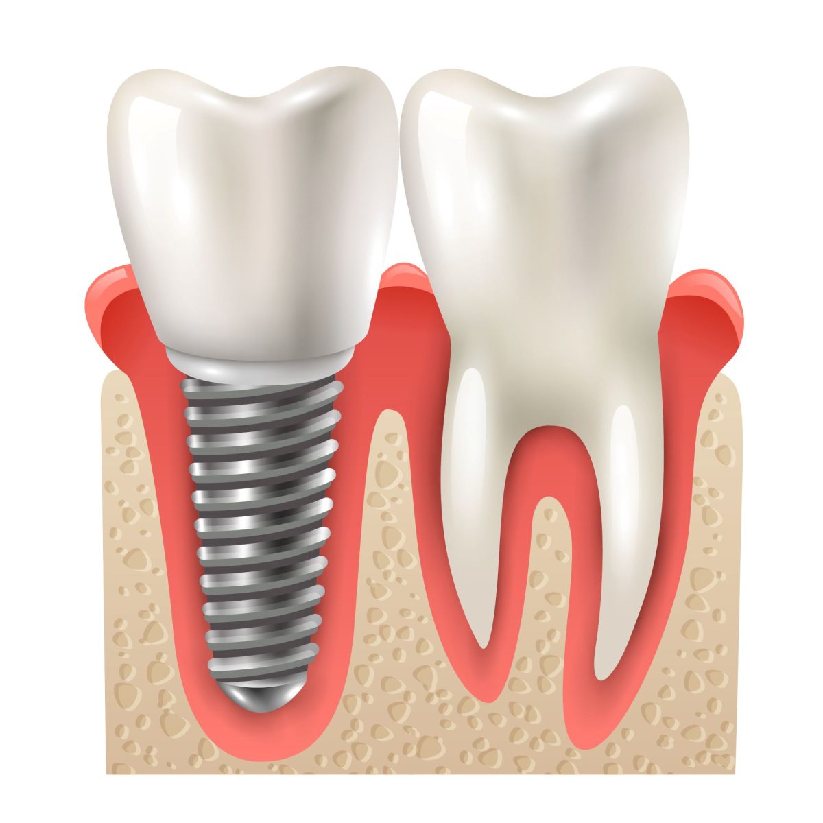 Imagen de un Implante dental